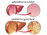 அமைதியாக இருந்து ஆளைக் கொல்லும் கல்லீரல் கொழுப்புக்களை சரிசெய்யும் கிராமத்து கை வைத்தியங்கள்!
