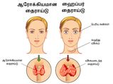 ஹைப்பர் தைராய்டு பிரச்சனையைக் கட்டுப்படுத்த சில எளிய இயற்கை வழிகள்!