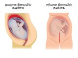 மருத்துவர்கள் எப்போது சிசேரியன் செய்ய வேண்டுமென கூறுவார்கள் தெரியுமா?