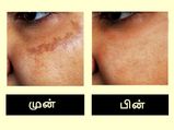 ஒரே வாரத்தில் முகத்தில் இருக்கும் ப்ரௌன் நிற புள்ளிகளைப் போக்கும் அற்புத வழிகள்!