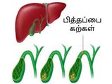  பித்தப்பை கற்கள் இருந்தால் மற்றொரு அபாயமும் உண்டாகும்! அது என்ன?