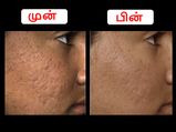 முகத்தில் அசிங்கமா மேடு பள்ளங்கள் உள்ளதா? அதை மறைக்க இதோ சில அற்புத வழிகள்!