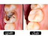 சொத்தைப் பல்லை இயற்கை வழியில் போக்குவது எப்படி?