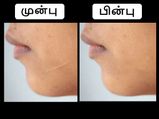 ஒரே வாரத்தில் சருமத்தில் இருக்கும் அசிங்கமான தழும்புகளைப் போக்க வேண்டுமா? அப்ப இத ட்ரை பண்ணுங்க...