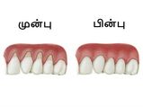 ஈறுகள் மேலே ஏறி அசிங்கமாக உள்ளதா? அதை சரிசெய்ய இதோ சில எளிய வழிகள்!