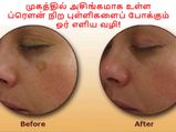 முகத்தில் அசிங்கமாக உள்ள ப்ரௌன் நிற புள்ளிகளைப் போக்க சரும நிபுணர் கூறும் ஓர் எளிய வழி!