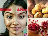 மூன்றே நாட்களில் முகத்தில் உள்ள கரும்புள்ளிகள் மறைய வேண்டுமா? அப்ப இத செய்யுங்க...