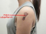 இப்படி வந்தா அதுவும் ஒருவகை புற்றுநோய்தானாம்... ஆனா உயிருக்கு பயப்படத் தேவையில்லை...
