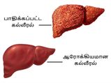 இந்த 5 அறிகுறி இருந்துச்சுன்னா உங்க ஈரல் காலின்னு அர்த்தம்... கவனமா இருந்துக்கோங்க...