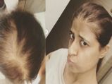 முடி கொட்டி கொட்டி உங்க தலை இப்படி ஆயிடுச்சா?... நீங்க ஏன் இத ட்ரை பண்ணக்கூடாது?
