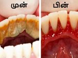 ஒரே வாரத்தில் பற்களின் பின் இருக்கும் அசிங்கமான மஞ்சள் கறையைப் போக்கும் அற்புத வழி!