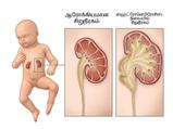 குழந்தைகளின் வயிற்றுப் பகுதி வீக்கி இருந்தா, அதுக்கு இந்த பிரச்சனை தான் காரணம்.. 
