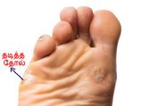 தடித்த தோல் பிரச்சனையை சரிசெய்ய உதவும் சில வீட்டு வைத்திய குறிப்புகள்!