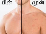 ஆண்களின் மார்பு பகுதியில் வரும் வலிமிக்க பருக்களைப் போக்கும் எளிய வழிகள்! 