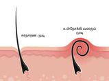 ஷேவ்விங் செய்த பிறகு சருமத்தில் உள்நோக்கி வளரும் முடிகளை தடுப்பது எப்படி?