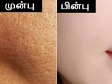 என்ன செஞ்சாலும் முகத்தில் இருக்கும் குழிகள் மறைய மாட்டீங்குதா? இந்த வழிகளை ட்ரை பண்ணுங்க...