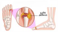 உடலில் இருக்கும் அதிகப்படியான யூரிக் அமிலத்தை இயற்கை முறையில் குறைக்கும் சில எளிய வழிகள்!