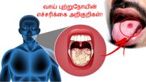 உங்க வாயில் இந்த அறிகுறிகள் 3 வாரத்துக்கு மேல் தெரியுதா? அப்ப உங்களுக்கு வாய் புற்றுநோய் இருக்குன்னு அர்த்தம்