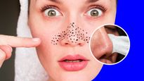 Skin Care: உங்க முகத்தில் இருக்கும் கரும்புள்ளிகளை வலியே இல்லாம நீக்கணுமா? இந்த வழிகளை ட்ரை பண்ணுங்க...!