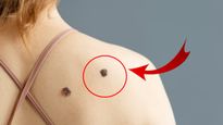 Skin Cancer: உங்க சருமத்தில் திடீரென்று இப்படி வந்துருக்கா? அப்படின்னா அது புற்றுநோயா இருக்கலாம்..