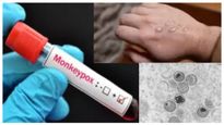 Mpox: அதிகரிக்கும் குரங்கு அம்மை.. விமான நிலையங்கள் மற்றும் மருத்துவமனைகளுக்கான வழிகாட்டுதல்கள் வெளியீடு...!