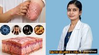 சொரியாசிஸ் பற்றி ஒவ்வொருவரும் கட்டாயம் தெரிஞ்சுக்க வேண்டிய விஷயங்களை பகிர்ந்து கொண்ட டாக்டர்! 