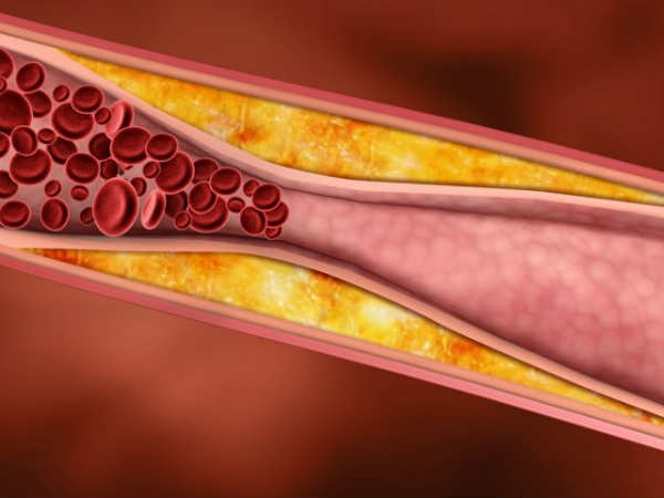 பெருந்தமனி தடிப்பு நோய் (atherosclerosis)