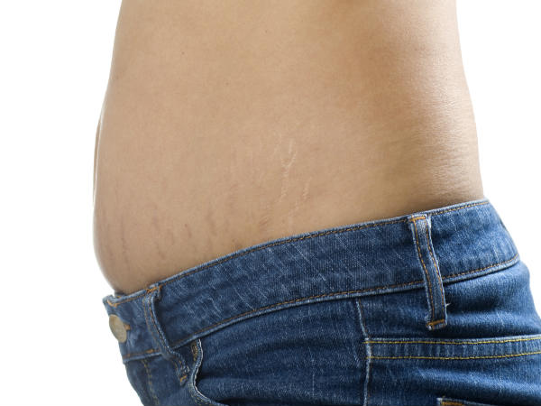 ஸ்ட்ரெட்ச் மார்க்