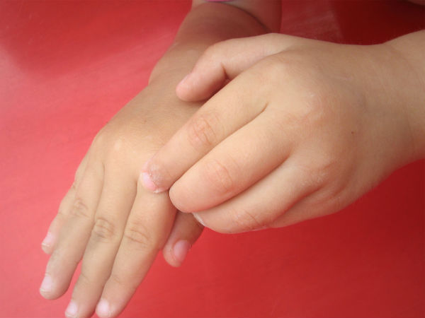 சொறி சிரங்கு