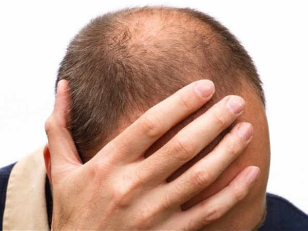 அலோபிஷியா ஏரியேட்டா (Alopecia Areata) 