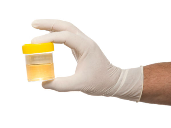 சிறுநீர் பரிசோதனை