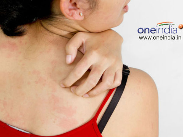 சொரியாசிஸ்/சரும அழற்சி 