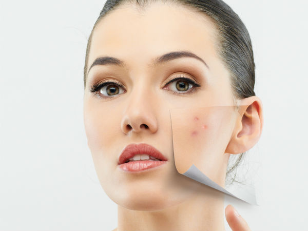 பருக்களைப் போக்க...