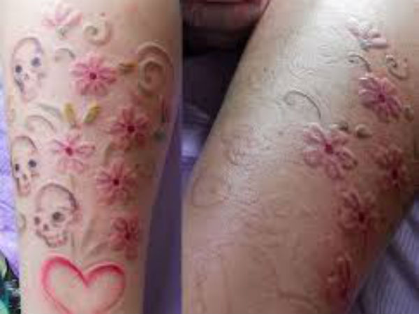 வடுக்கள்