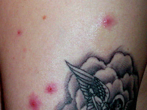 சரும தொற்றுகள்