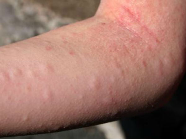 நிணநீர் அமைப்பு சுமை