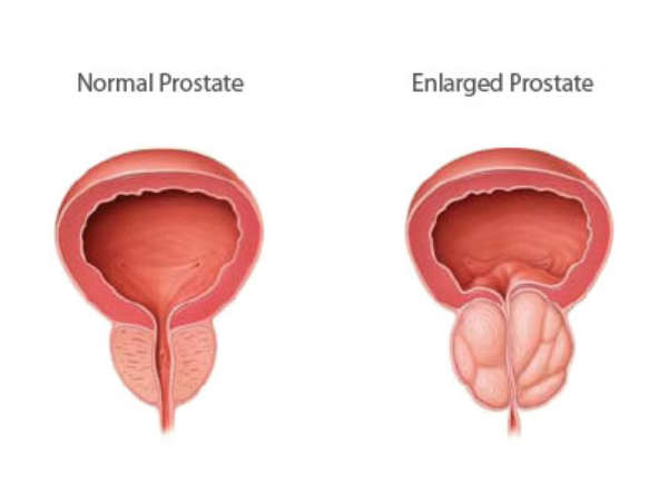  புரோஸ்டேட் சுரப்பி வீக்கத்திற்கான சிகிச்சையும் தடுப்பும்