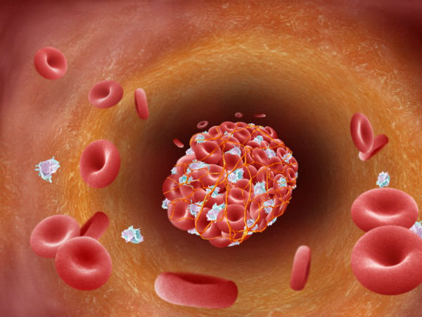 இரத்த கட்டி 