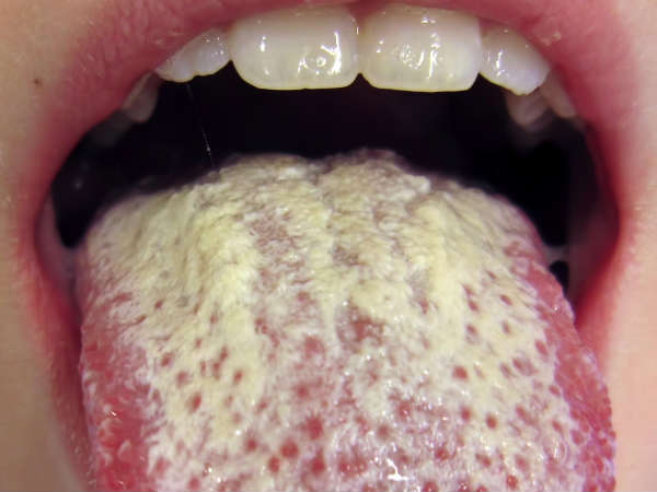 நாக்கில் சுருக்கங்கள் - பூஞ்சைத் தொற்று