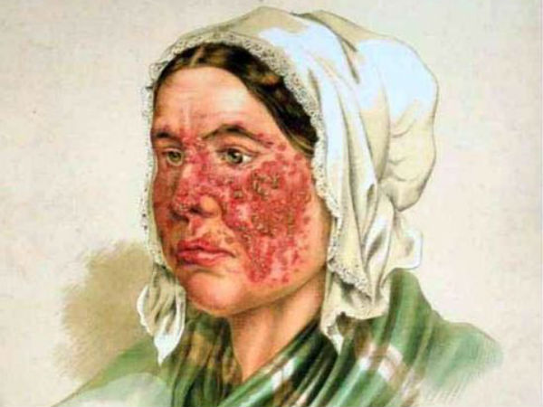 லூபஸ் (Lupus) 