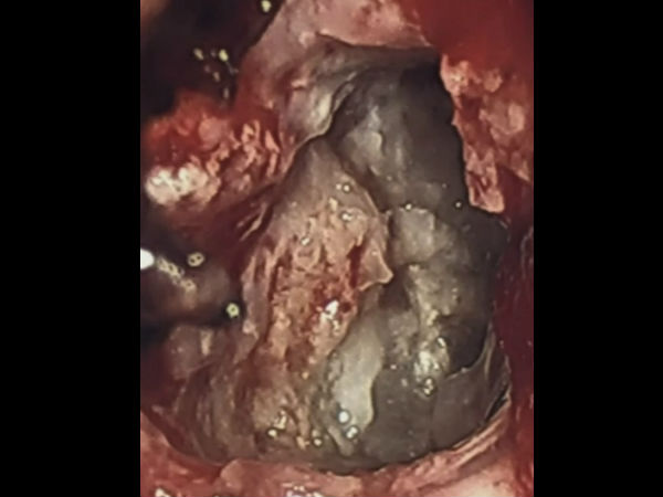 கீ-ஹோல் அறுவை சிகிச்சை 