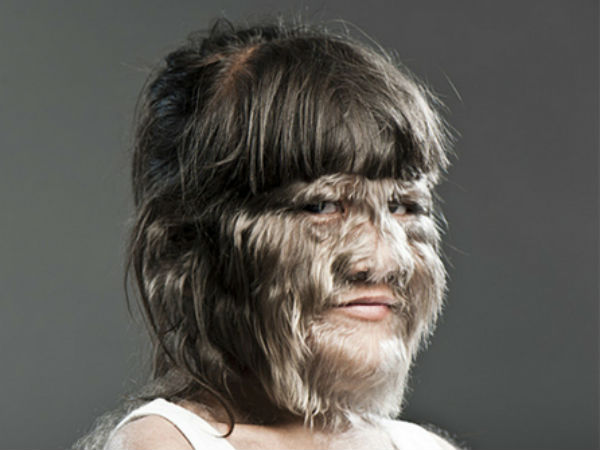 ஓநாய் நோய் - Werewolf Syndrome 