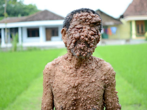 நியூரோபைப்ரோமடோசிஸ் - Neurofibromatosis 