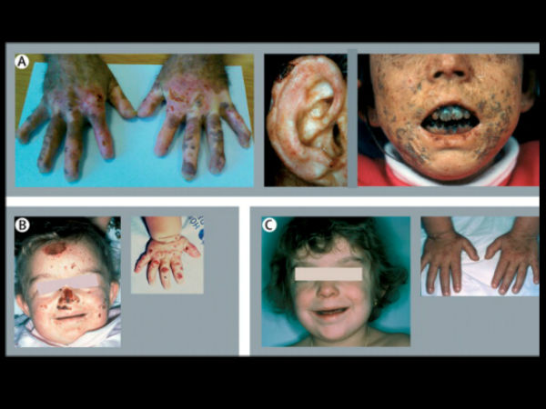 காட்டேரி நோய் - Prophyria / Vampire Disease 