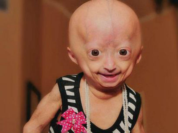முதிராமுதுமை - Progeria (HGPS) 