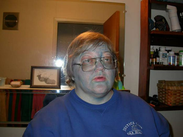 ஆர்க்யுரியா - Argyria 