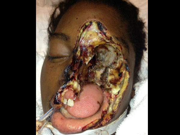 நேக்ரோடிசிங் ஃபேச்சிடிஸ் - Necrotisting Fasciitis 