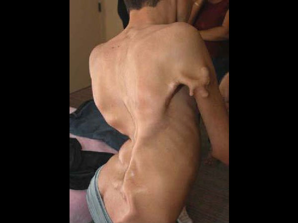 எப்.ஓ.பி (Fibrodysplasia Ossificans Progressiva - FOP) 