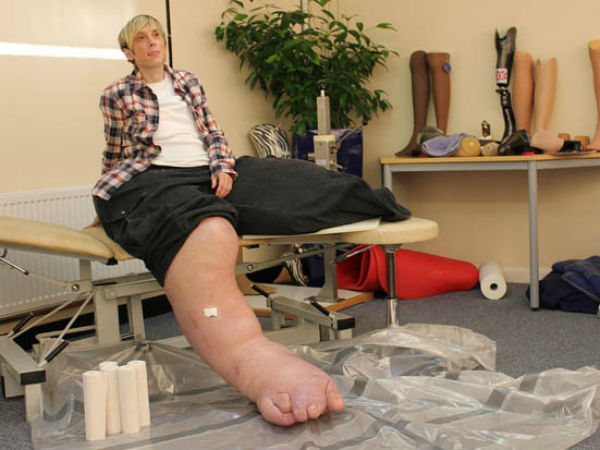 ப்ரோட்டஸ் சிண்ட்ரோம் 