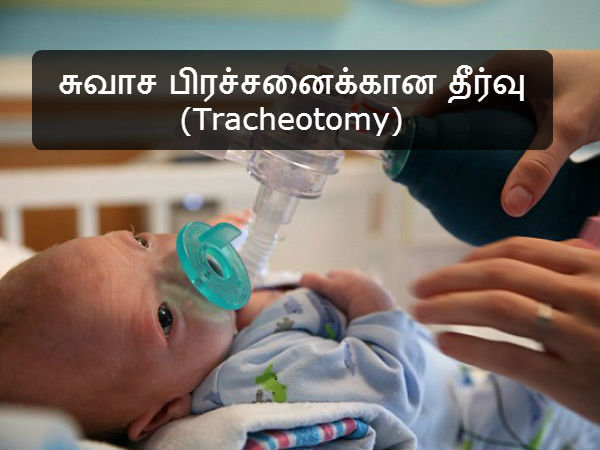 சுவாச பிரச்சனைக்கான தீர்வு (Tracheotomy) 